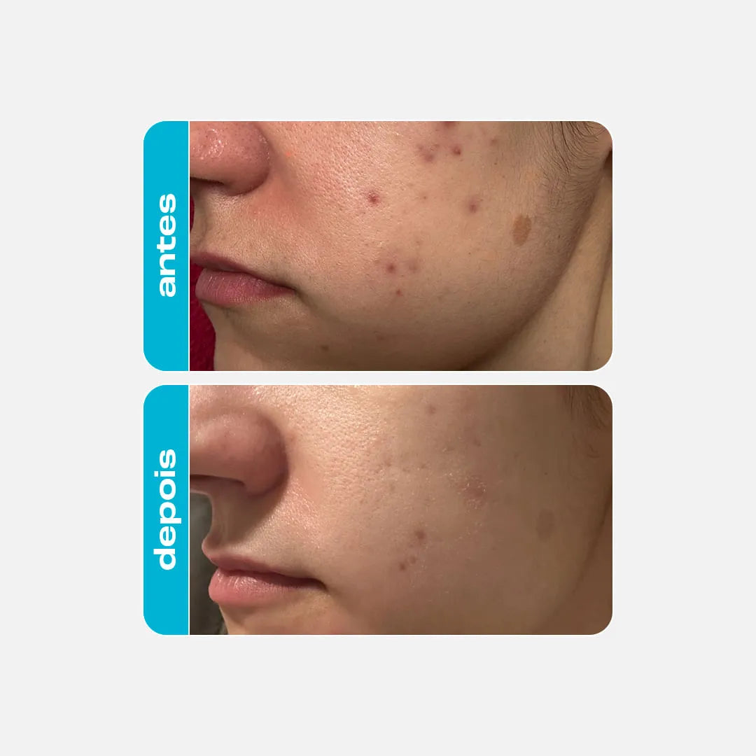 Esfoliante Químico - Ácido Glicólico